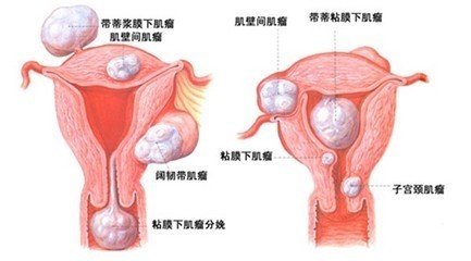 子宫肌瘤怎么治疗效果最好