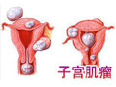 治疗子宫肌瘤常见的误区