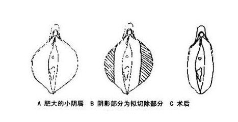 小阴唇整形疼吗