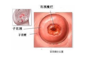 造成宫颈糜烂的原因