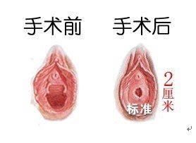 处女膜修复价格