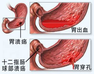 胃溃疡的发病症状