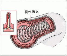 慢性肠炎正确的预防方法是什么？