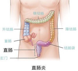 直肠炎患者需要做哪些检查?