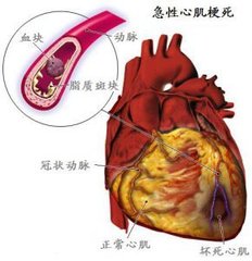 急性心肌梗死的原因