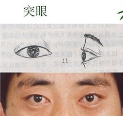 甲亢突眼的症状有哪些?