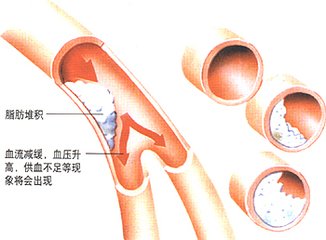 高血脂的主要症状都有哪些?