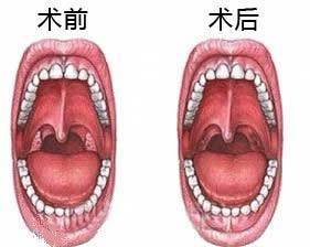 扁桃体炎会不会传染