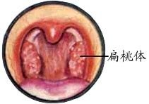 扁桃体肥大的症状有哪些？