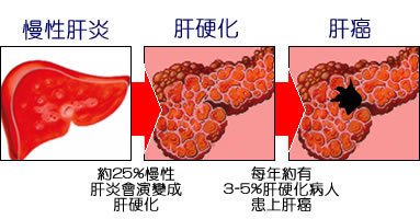 乙肝肝硬化患者传染吗