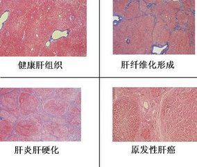 肝纤维化的早期症状是哪些？