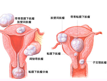 治疗子宫肌瘤术前检查时关键