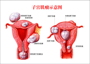 子宫肌瘤都有哪些类型