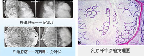 什么是乳腺纤维瘤？